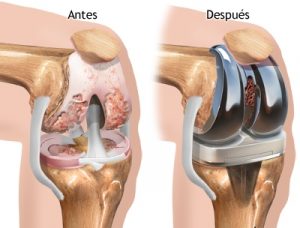 Prótesis de rodilla