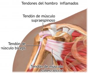Rotura de tendones. Manguito rotador