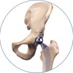 Lesiones de la cadera.Prótesis