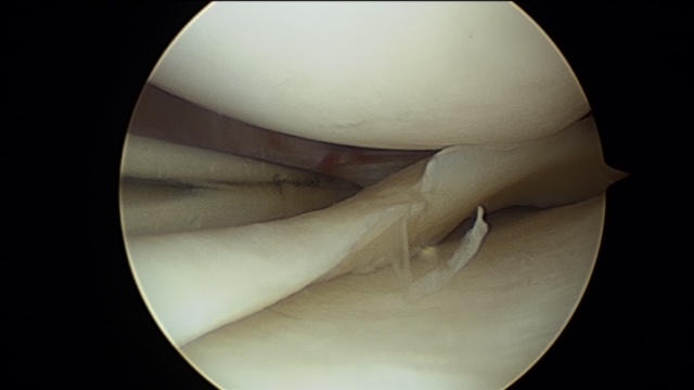 Lesiones de menisco. Costura 1