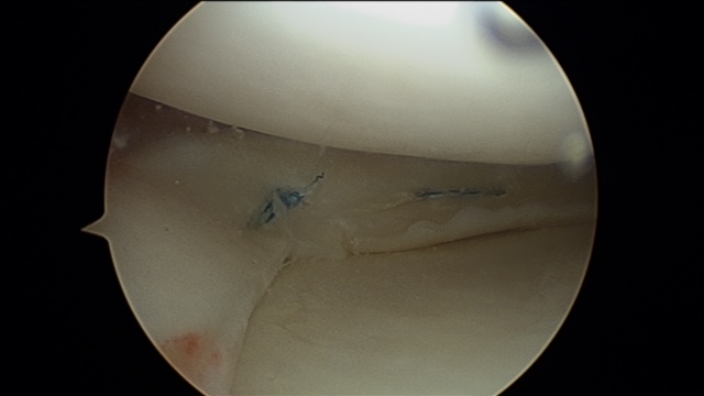 Lesiones de menisco. Costura 3