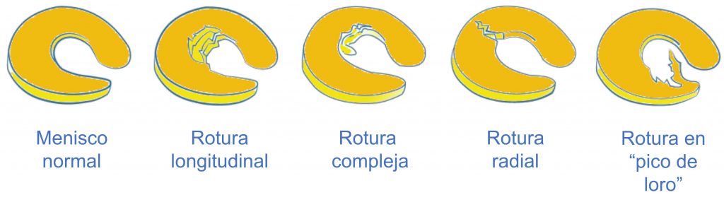 Lesiones de menisco. Tipos de roturas