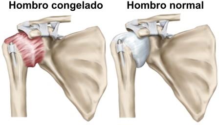 hombro congelado o capsulitis