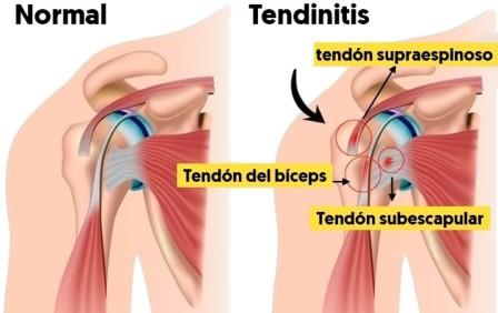 tendinitis habitual