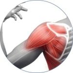 tendinitis cálcica